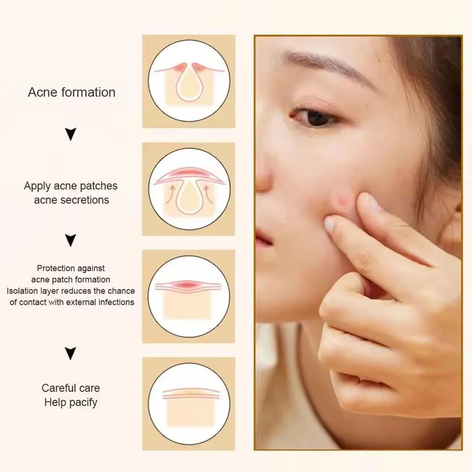Pimple Emergency? Patch It Overnight! – Hydrocolloid Acne Healing Patches